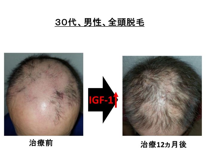 円形脱毛症　病院